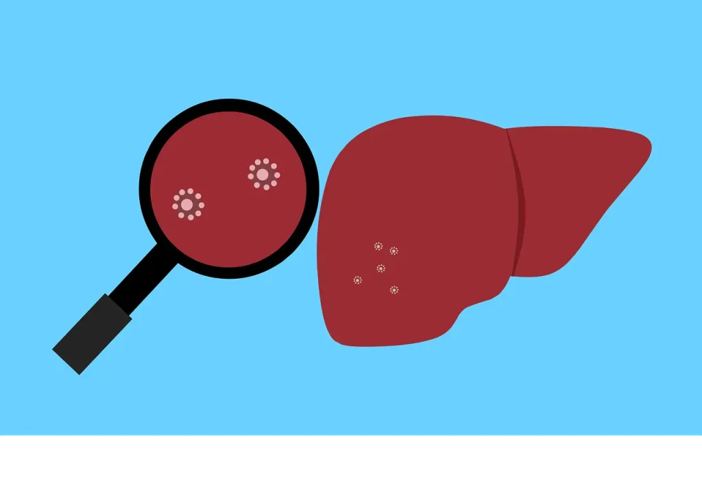 Rak wątroby